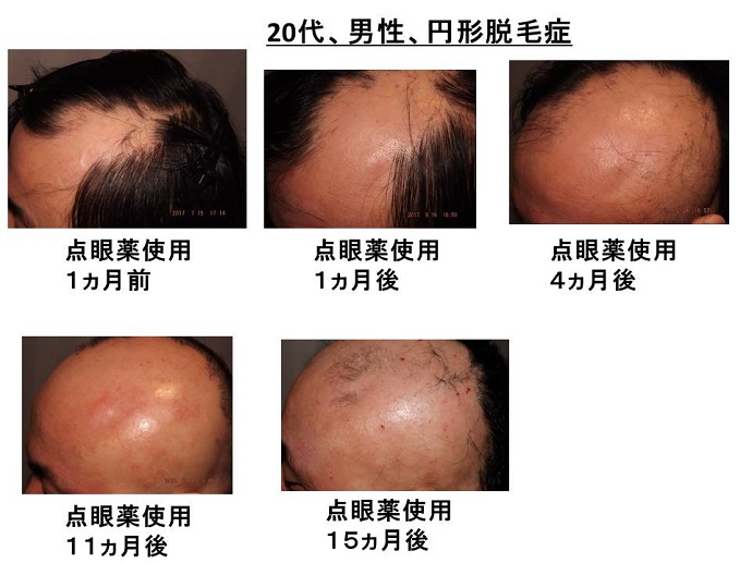 円形脱毛症　病院